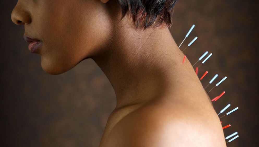 Agopuntura con osteocondosi cervicale