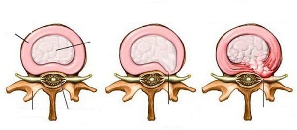 Ernia vertebrale intermedia con osteocondosi cervicale
