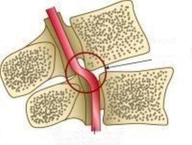 Sindrome di Vail Arteries