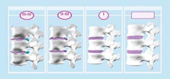 Stadi di osteocondosi cervicale