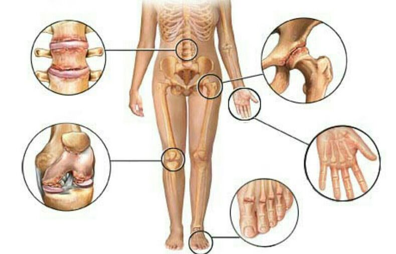 Tipi e gradi di osteoartrite